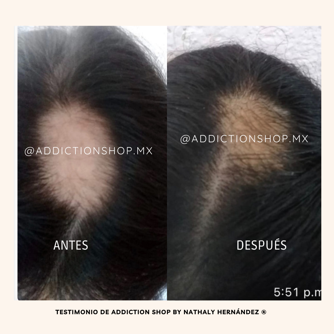 Kit Plus* - Anticaída + Crecimiento reforzado